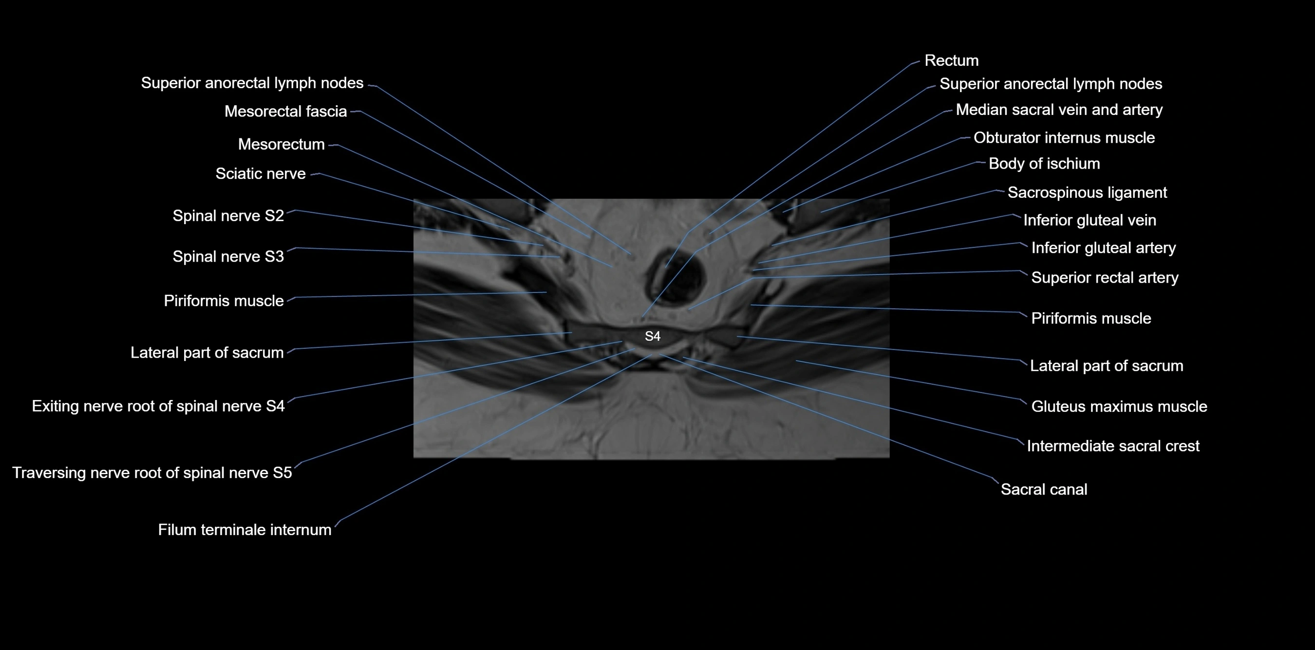 MRI sacrum, coccyx and sacroiliac joint axial cross sectional anatomy 3T  radiology  image-img-00001-00051.webp